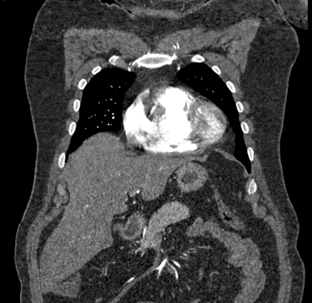 Acute pulmonary embolism with pulmonary infarcts (Radiopaedia 77688-89908 Coronal C+ CTPA 13).jpg