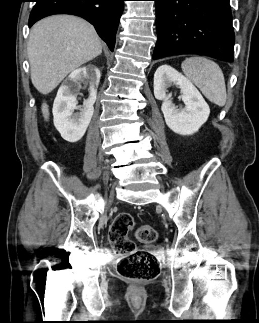 Acute renal infarction - rim capsular enhancement (Radiopaedia 59833-67270 Coronal C+ portal venous phase 41).jpg