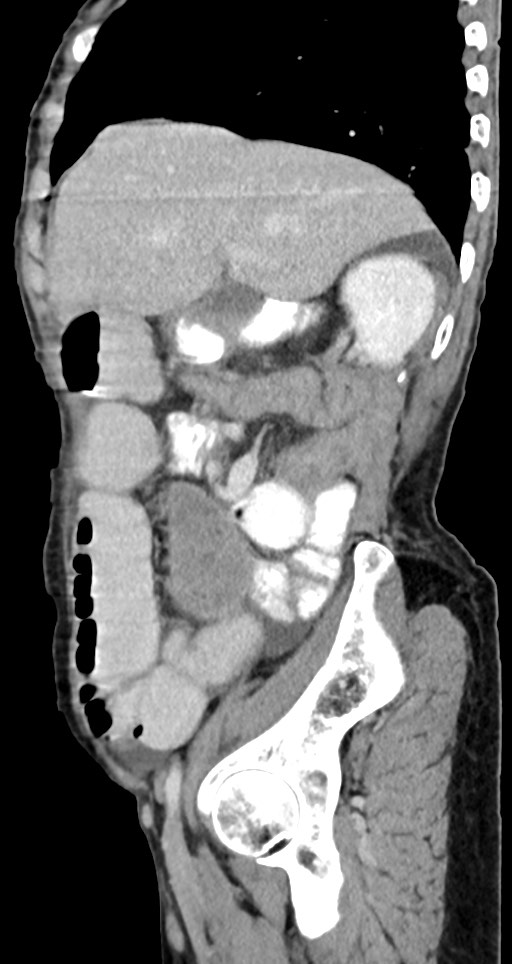 Acute small bowel (ileal) volvulus (Radiopaedia 71740-82139 Sagittal C+ portal venous phase 118).jpg