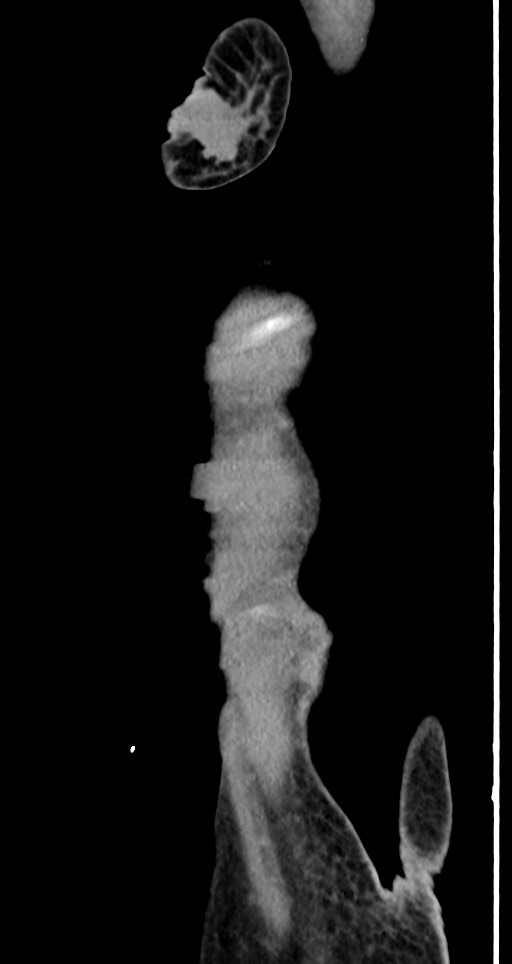 Acute small bowel (ileal) volvulus (Radiopaedia 71740-82139 Sagittal C+ portal venous phase 153).jpg