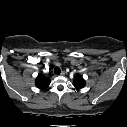 Acute subarachnoid hemorrhage and accessory anterior cerebral artery (Radiopaedia 69231-79009 Axial C+ arterial phase 25).jpg