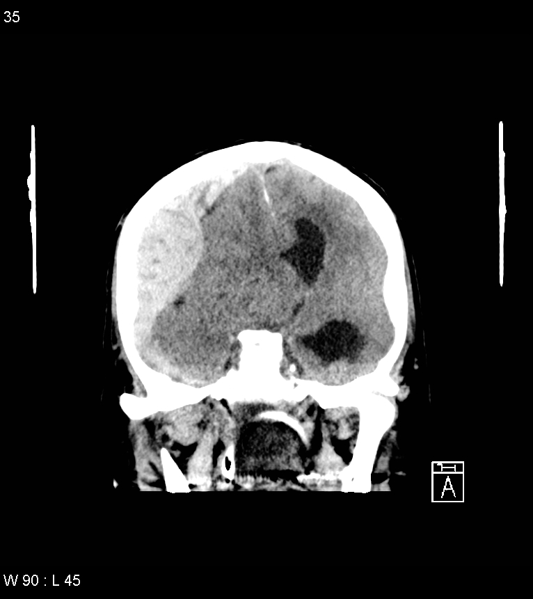 Acute subdural hematoma with myelofibrosis (Radiopaedia 52582-58494 Coronal non-contrast 26).jpg