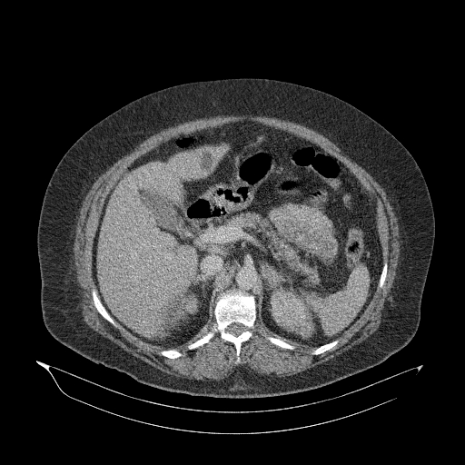 File:Acute superior mesenteric artery occlusion (Radiopaedia 51288-56960 Axial C+ portal venous phase 32).jpg