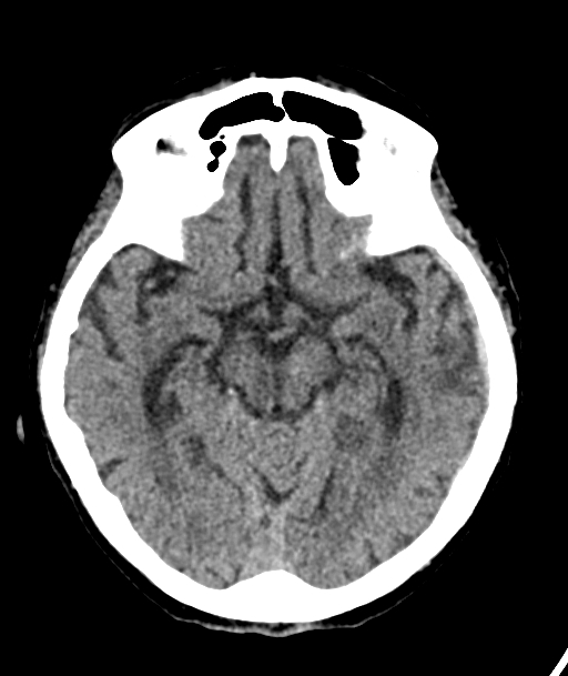 Acute traumatic subdural hematoma (Radiopaedia 82921-97257 Axial non-contrast 40).jpg