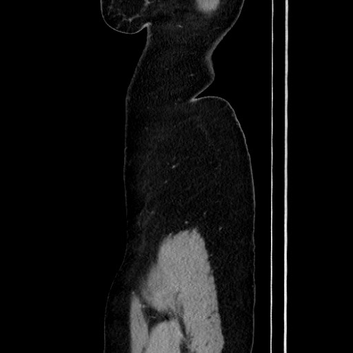 Acute uncomplicated appendicitis (Radiopaedia 73704-84499 Sagittal C+ portal venous phase 39).jpg