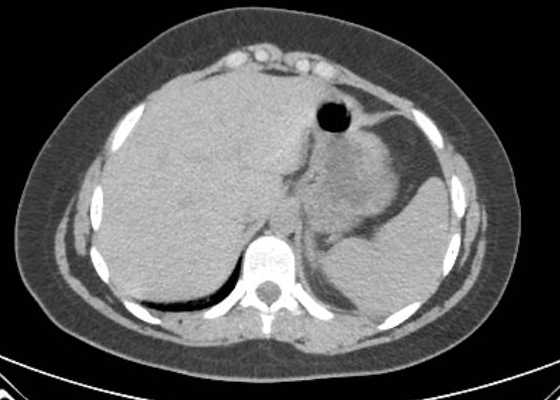 Acute unilateral nonhemorrhagic adrenal infarction (Radiopaedia 67560-76957 Axial non-contrast 11).jpg