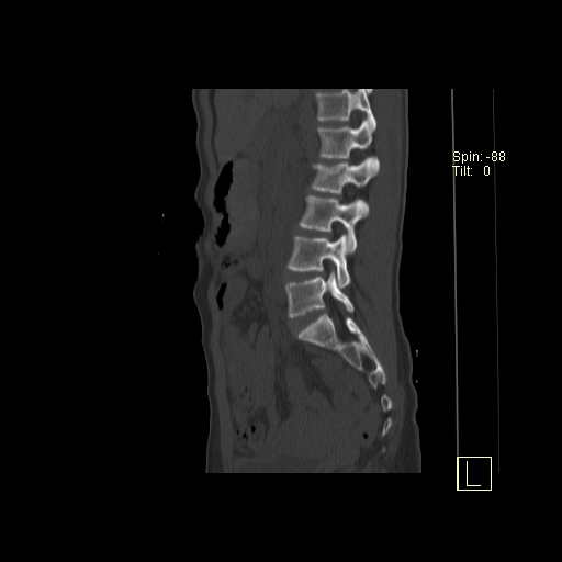 File:Acute vertebral compression fracture (Radiopaedia 63832-72559 Sagittal bone window 18).jpg