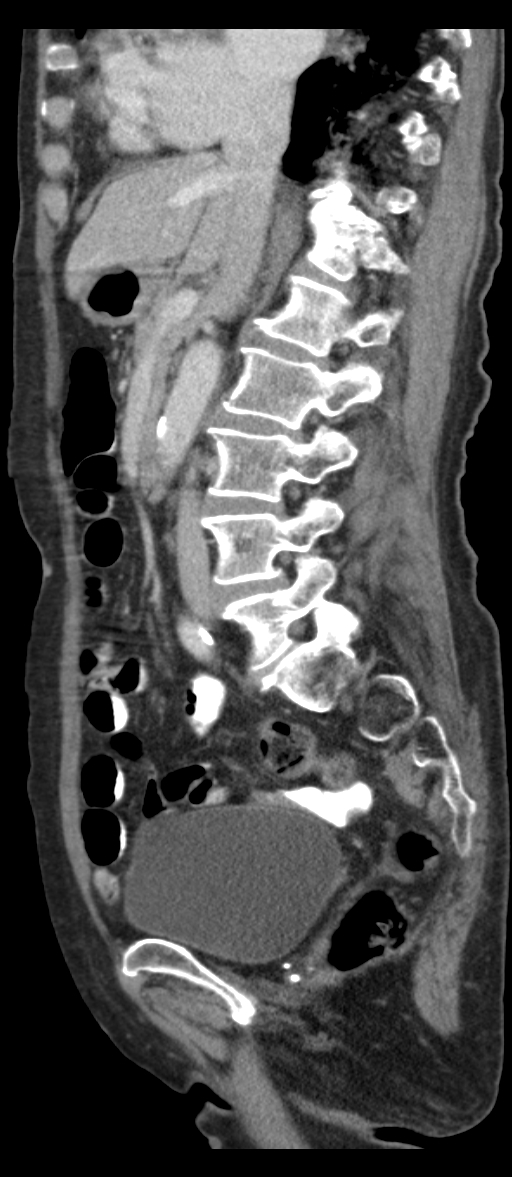 Adenocarcinoma of cecum (Radiopaedia 59222-66549 Sagittal C+ portal venous phase 53).jpg