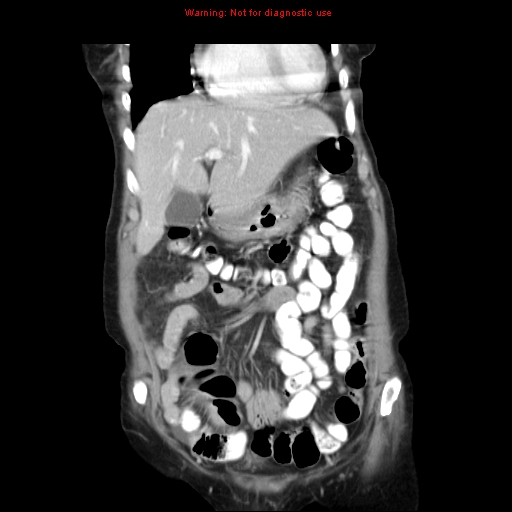 File:Adenocarcinoma of the colon (Radiopaedia 8191-9039 Coronal liver window 13).jpg