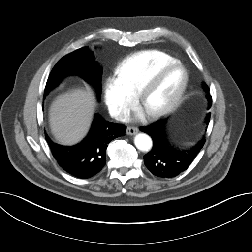 File:Adenocarcioma of rectum- T1 lesion (Radiopaedia 36921-38547 Axial C+ arterial phase 40).png