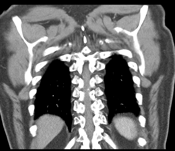 Adenocarcioma of rectum- T1 lesion (Radiopaedia 36921-38547 Coronal C+ arterial phase 52).png