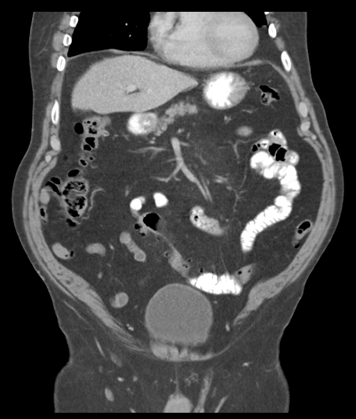 Adenocarcioma of rectum- T1 lesion (Radiopaedia 36921-38547 Coronal C+ portal venous phase 22).png