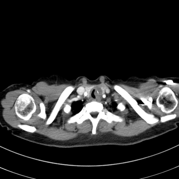 Adenocystic carcinoma of the trachea (Radiopaedia 47677-52525 Axial C+ arterial phase 29).jpg
