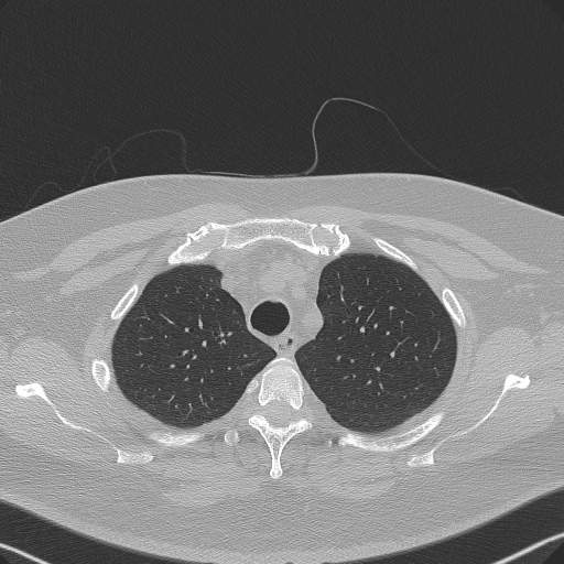 Adenoid cystic carcinoma of the trachea (Radiopaedia 49042-54137 Axial lung window 71).jpg
