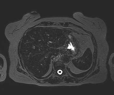 File:Adenomyomatosis of the gallbladder (Radiopaedia 50246-55587 Axial 100).png