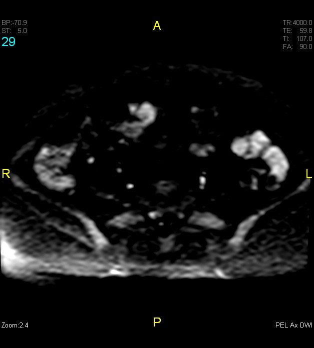 Adenomyosis (Radiopaedia 43504-46889 Axial DWI 29).jpg