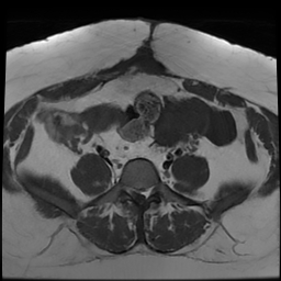 File:Adenomyosis within a didelphys uterus (Radiopaedia 70175-80215 Axial T1 14).jpg