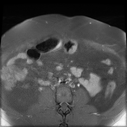 File:Adenomyosis within a didelphys uterus (Radiopaedia 70175-80215 Axial T1 C+ fat sat 4).jpg