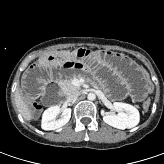 Adhesional small bowel obstruction (Radiopaedia 48397-53305 Axial C+ portal venous phase 25).jpg