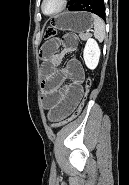Adhesional small bowel obstruction (Radiopaedia 58900-66131 Sagittal C+ portal venous phase 198).jpg