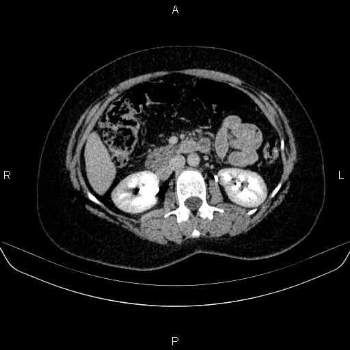 Adrenal cortical carcinoma (Radiopaedia 84882-100379 Axial C+ delayed 38).jpg