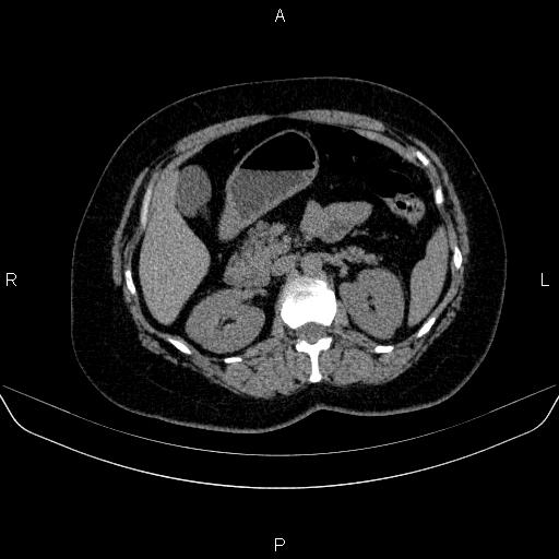 File:Adrenal cortical carcinoma (Radiopaedia 84882-100379 Axial non-contrast 33).jpg