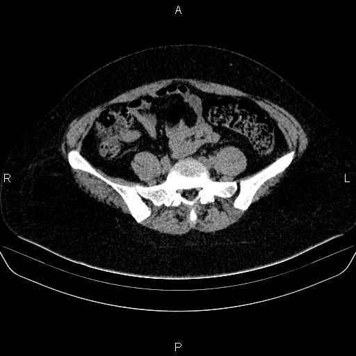 File:Adrenal cortical carcinoma (Radiopaedia 84882-100379 Axial non-contrast 66).jpg