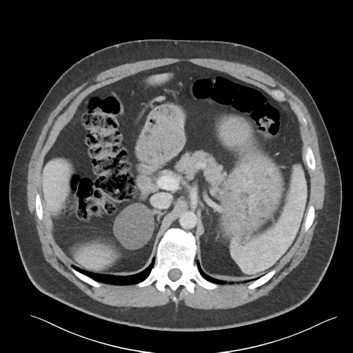 File:Adrenal cyst (Radiopaedia 45625-49777 Axial C+ portal venous phase 33).png