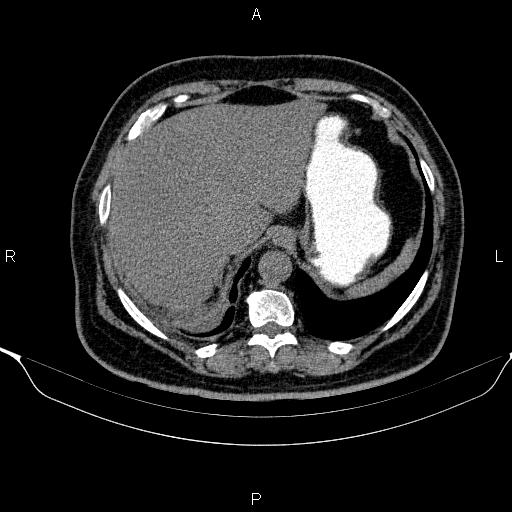 Adrenal hemorrhage (Radiopaedia 62622-70916 Axial non-contrast 27).jpg