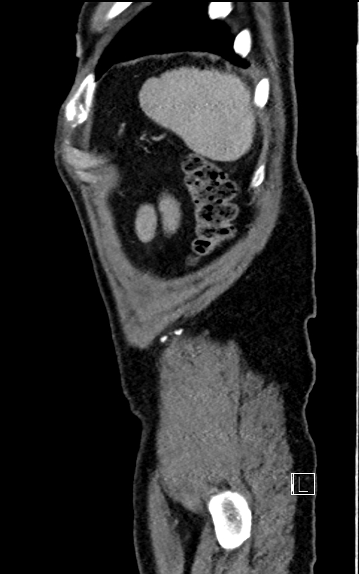 Adrenal lymphoma (Radiopaedia 73730-84529 Sagittal C+ portal venous phase 103).jpg