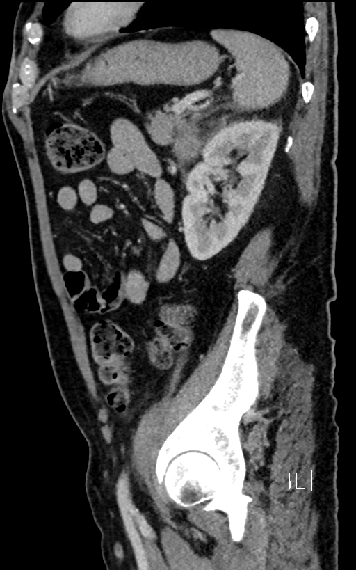 Adrenal lymphoma (Radiopaedia 73730-84529 Sagittal C+ portal venous phase 82).jpg