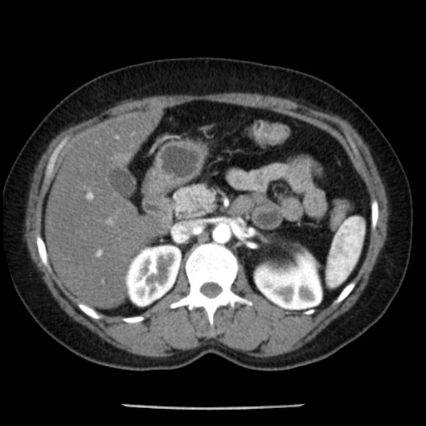 Adrenal myelolipoma (Radiopaedia 43401-46759 Axial C+ arterial phase 36).jpg