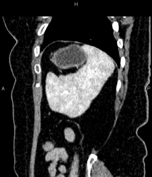 Adrenal myelolipoma (Radiopaedia 82742-96986 Sagittal renal cortical phase 89).jpg