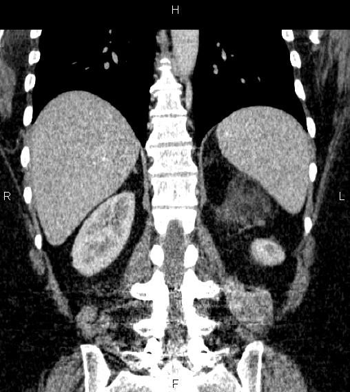 Adrenal myelolipoma (Radiopaedia 84319-99617 Coronal renal cortical phase 57).jpg