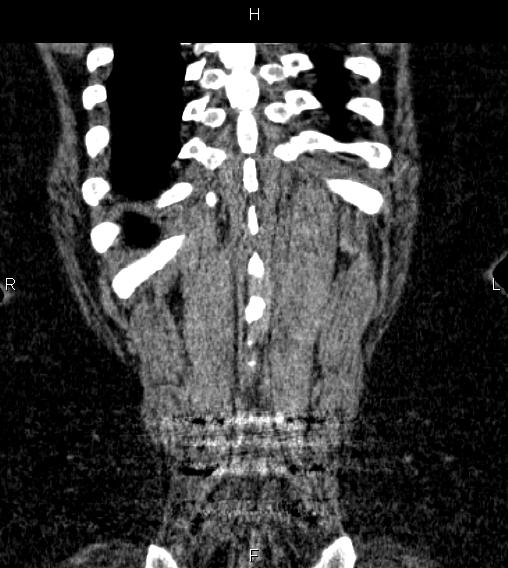 Adrenal myelolipoma (Radiopaedia 84319-99617 Coronal renal cortical phase 72).jpg