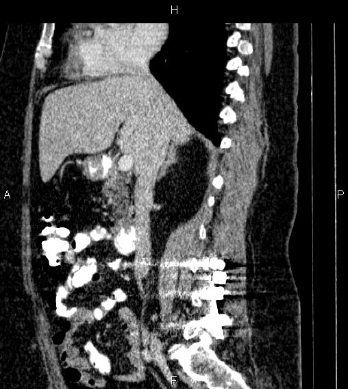 Adrenal myelolipoma (Radiopaedia 84319-99617 Sagittal renal cortical phase 39).jpg