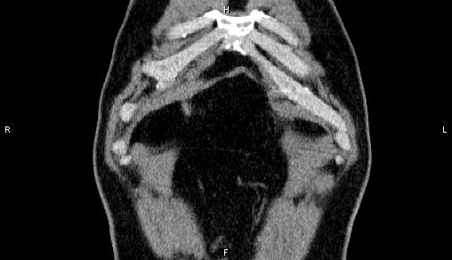 Adrenal myelolipoma (Radiopaedia 84321-99619 Coronal non-contrast 4).jpg