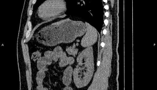 Adrenal myelolipoma (Radiopaedia 84321-99619 Sagittal non-contrast 79).jpg