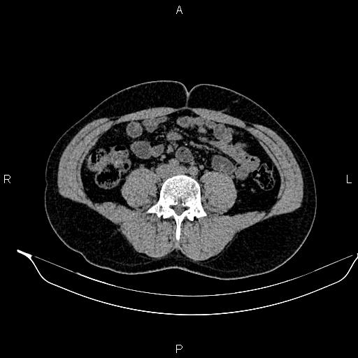 Adrenal myelolipoma (Radiopaedia 87794-104246 Axial non-contrast 65).jpg