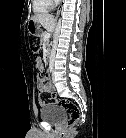Adrenal myelolipoma (Radiopaedia 87794-104246 Sagittal renal cortical phase 48).jpg