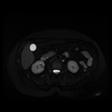 File:Adrenal myelolipoma - MRI (Radiopaedia 83249-97646 Axial STIR 22).jpg