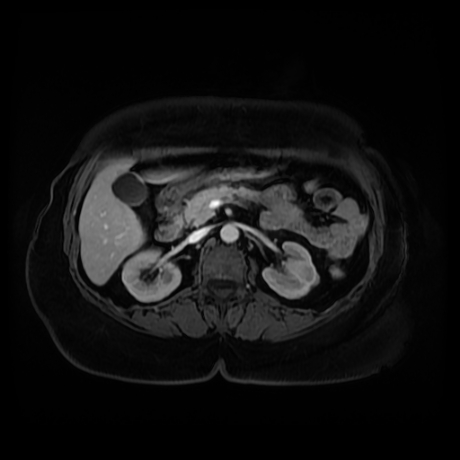 Adrenal myelolipoma - MRI (Radiopaedia 83249-97646 T1 fat sat arterial phase 42).jpg