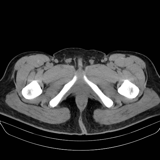 Adrenal myelolipoma - bilateral (Radiopaedia 74805-85810 Axial non-contrast 90).jpg