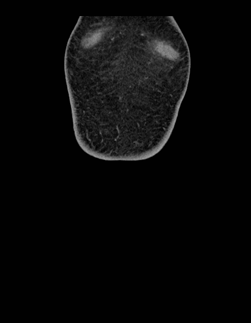 Adrenal myelolipoma - bilateral (Radiopaedia 74805-85810 Coronal C+ portal venous phase 264).jpg