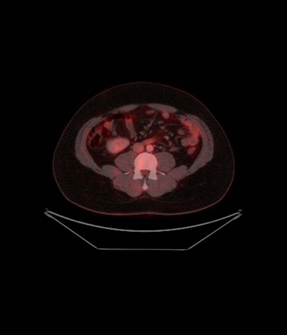 Adrenocortical carcinoma (Radiopaedia 80134-93440 ِAxial 197).jpg
