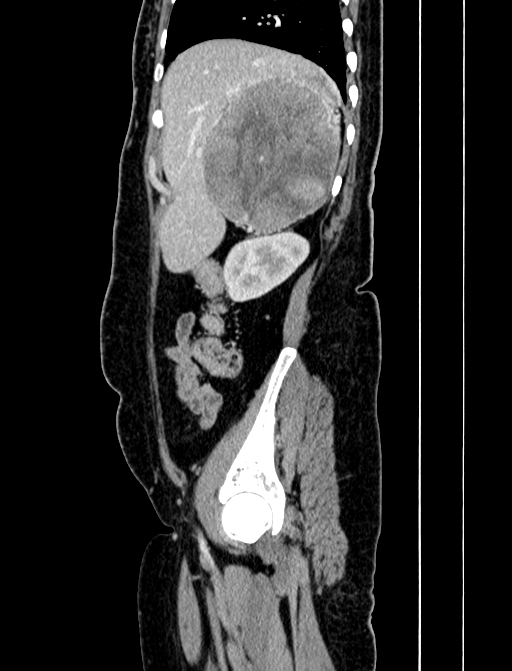 Adrenocortical carcinoma (Radiopaedia 87281-103569 Sagittal C+ portal venous phase 59).jpg