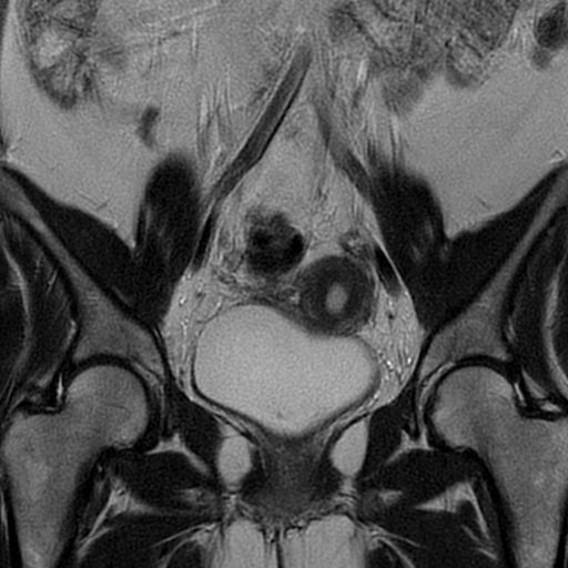 File:Adult granulosa cell tumor of the ovary (Radiopaedia 64991-73953 Coronal T2 11).jpg
