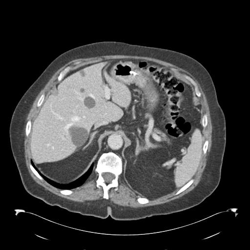 Adult ileal intussusception with secondary obstruction (Radiopaedia 30395-31051 Axial C+ portal venous phase 16).jpg