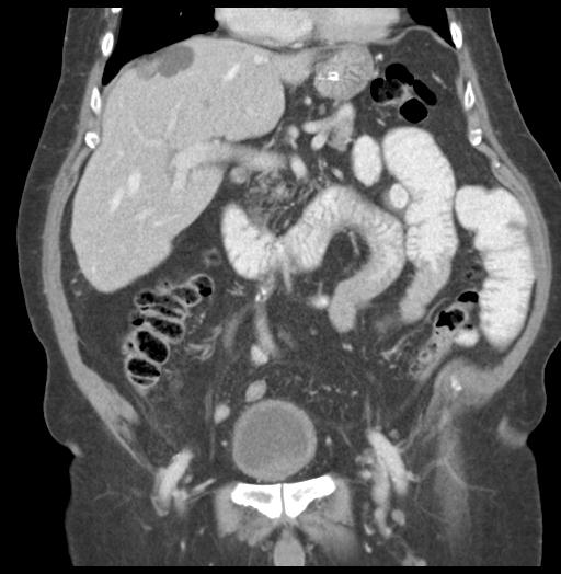 Adult ileal intussusception with secondary obstruction (Radiopaedia 30395-31051 Coronal C+ portal venous phase 28).jpg