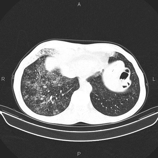 File:Air bronchogram in pneumonia (Radiopaedia 85719-101512 Axial lung window 54).jpg